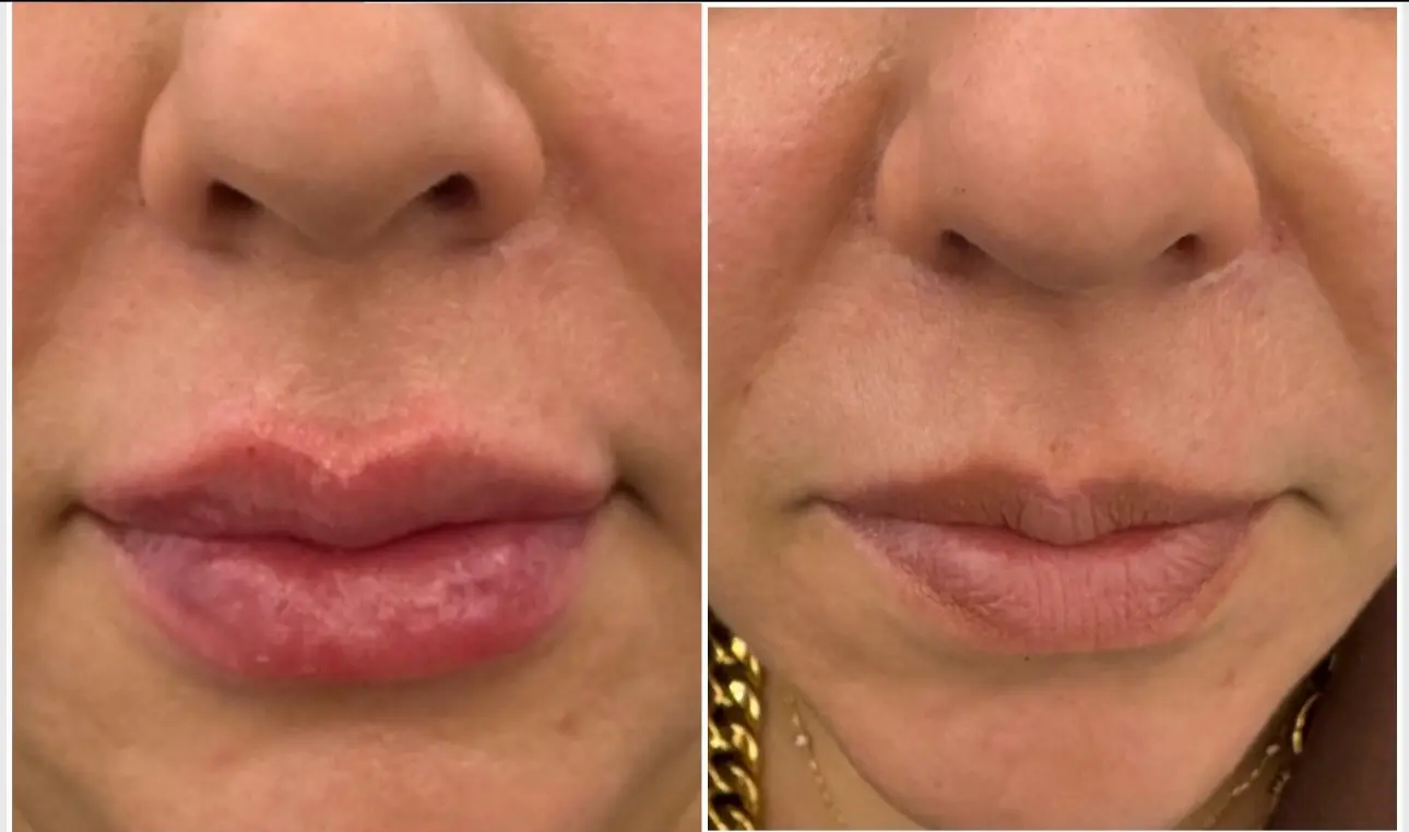 Before and after result 3